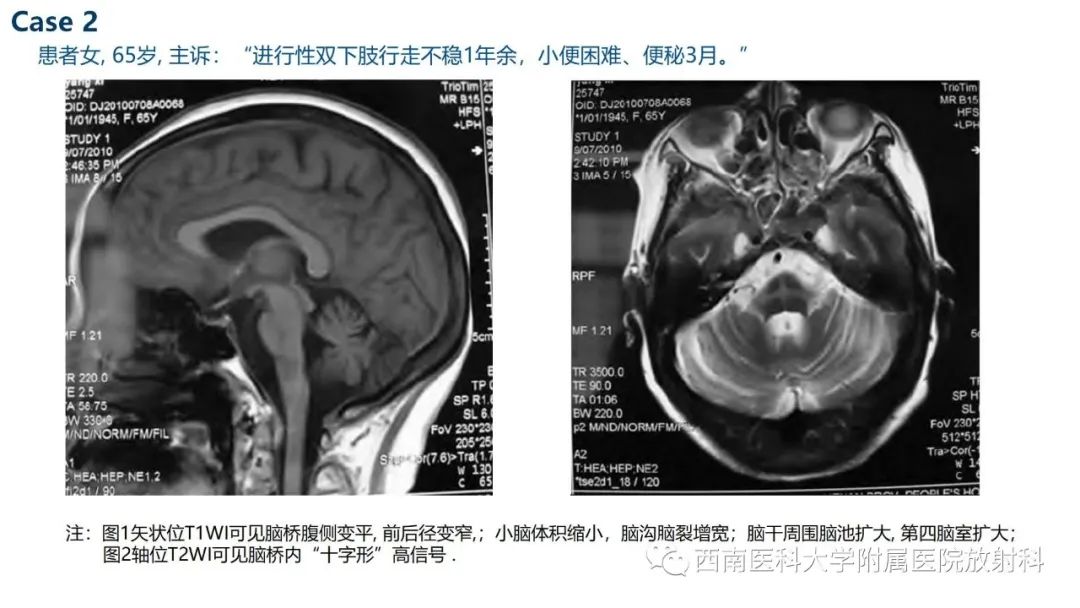 影像PPT - 【PPT】多系统萎缩-12