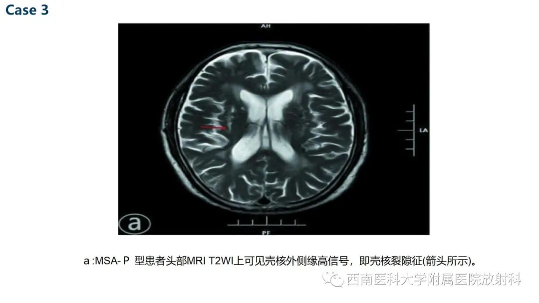 影像PPT - 【PPT】多系统萎缩-13