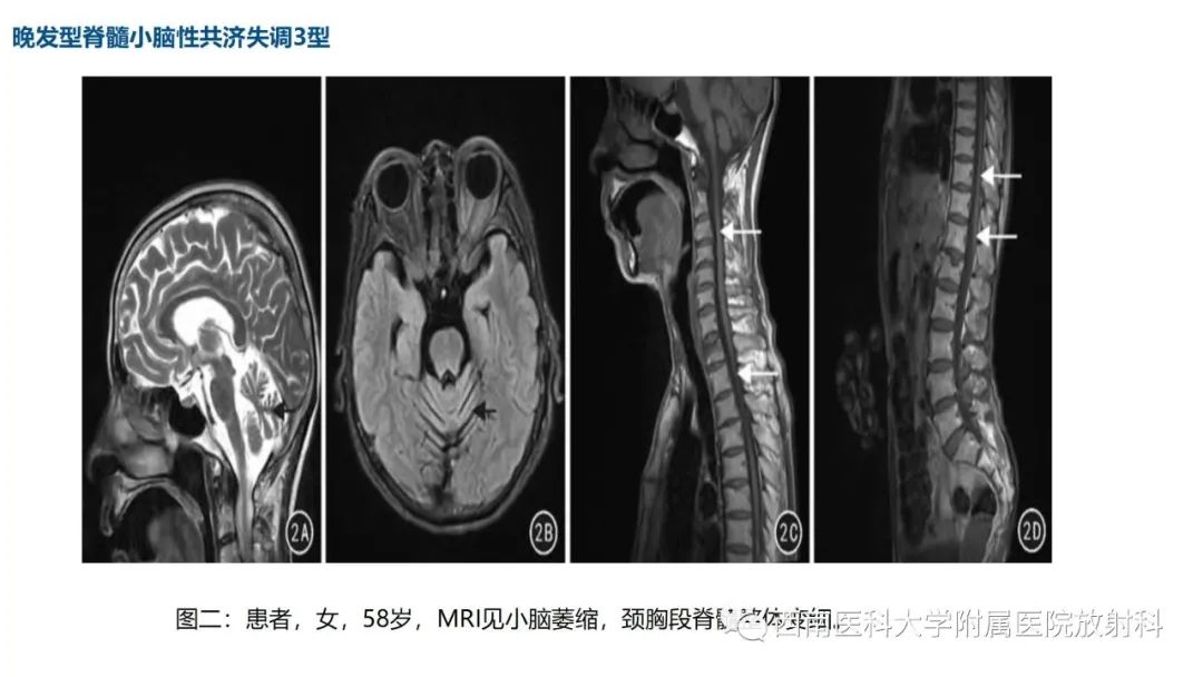 影像PPT - 【PPT】多系统萎缩-15