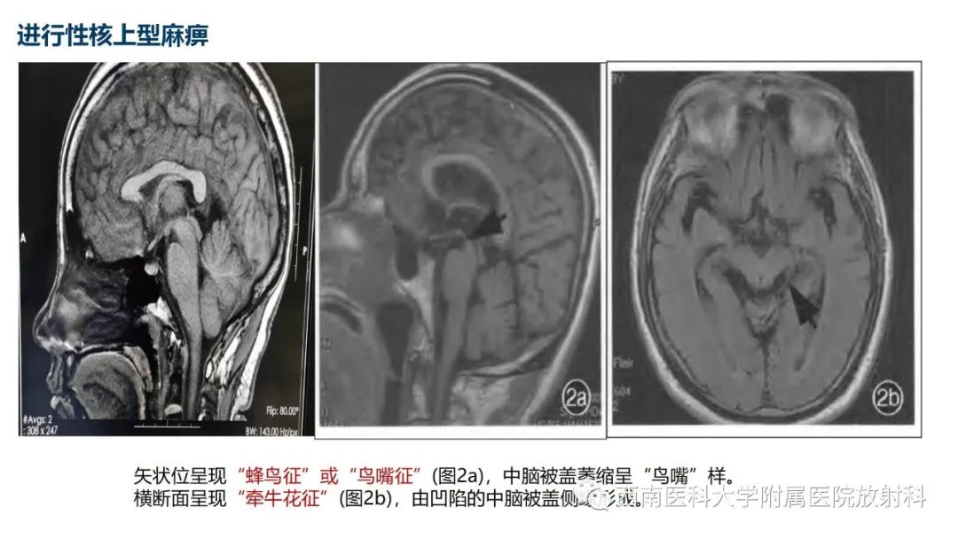 影像PPT - 【PPT】多系统萎缩-18