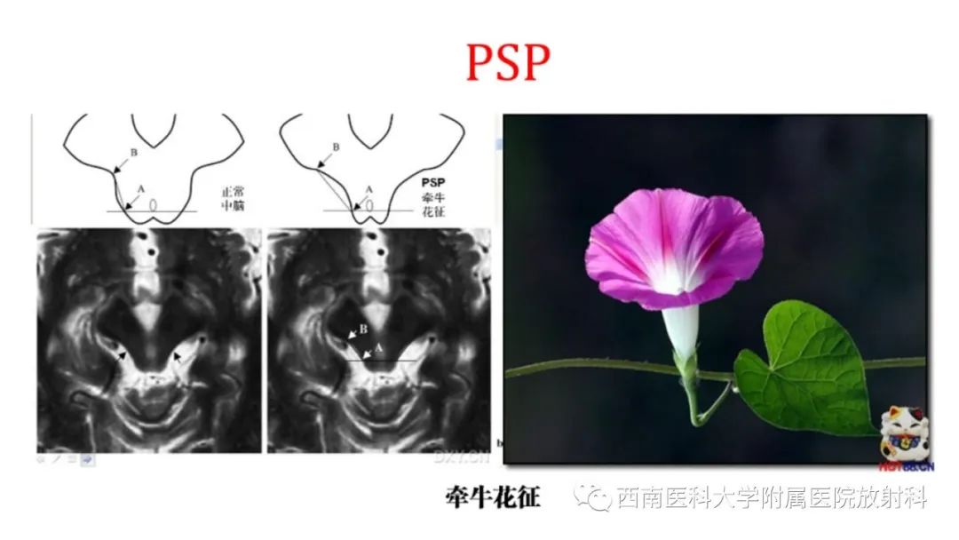 影像PPT - 【PPT】多系统萎缩-20