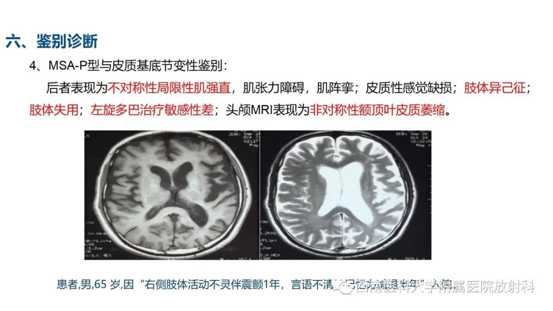 影像PPT - 【PPT】多系统萎缩-21