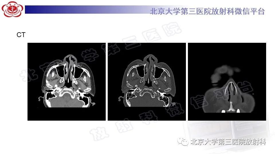 影像PPT - 【PPT】鼻腔鼻窦恶性黑色素瘤-3
