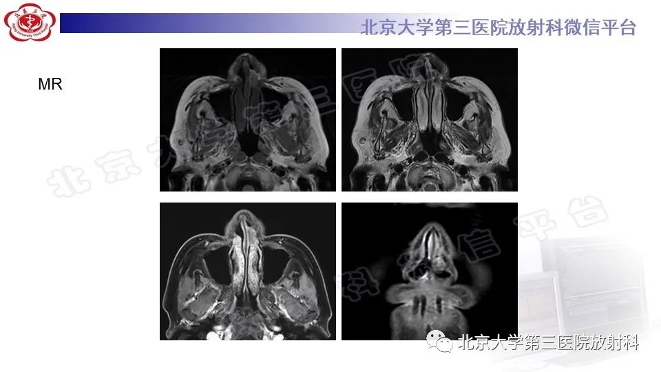 影像PPT - 【PPT】鼻腔鼻窦恶性黑色素瘤-4
