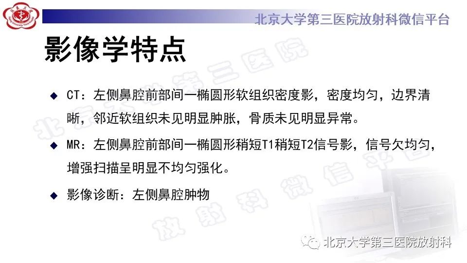 影像PPT - 【PPT】鼻腔鼻窦恶性黑色素瘤-5