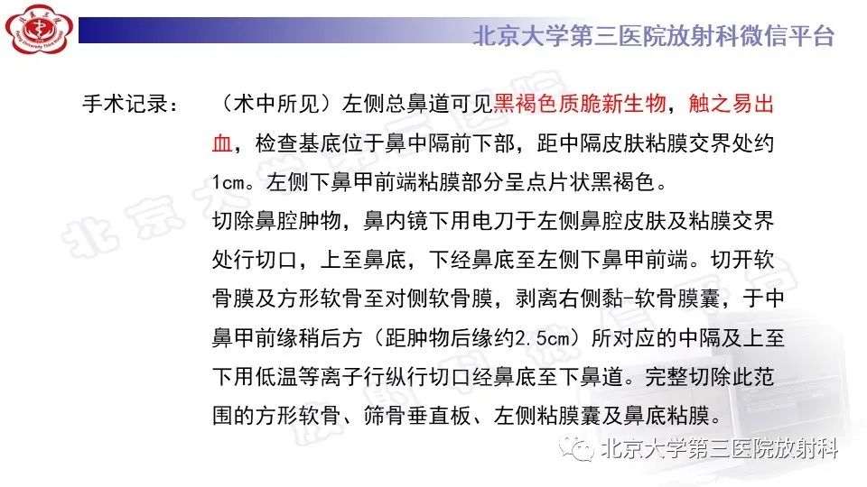 影像PPT - 【PPT】鼻腔鼻窦恶性黑色素瘤-8