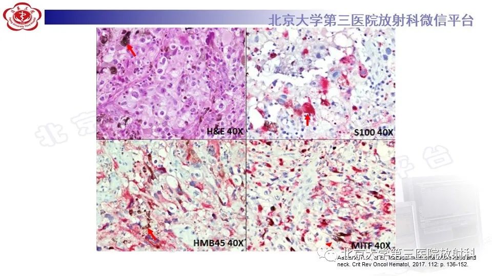 影像PPT - 【PPT】鼻腔鼻窦恶性黑色素瘤-15