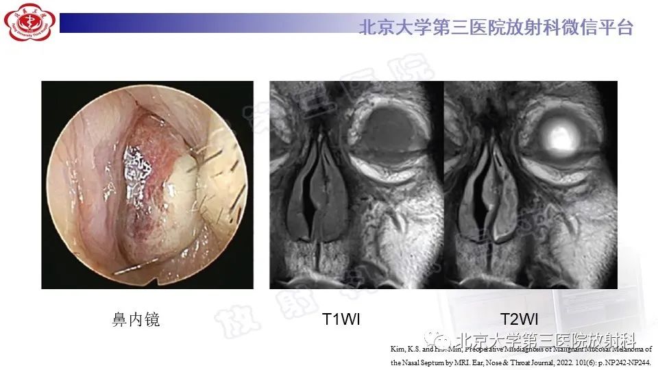 影像PPT - 【PPT】鼻腔鼻窦恶性黑色素瘤-18