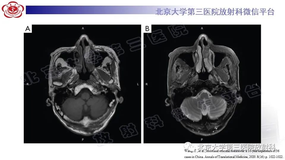 影像PPT - 【PPT】鼻腔鼻窦恶性黑色素瘤-17