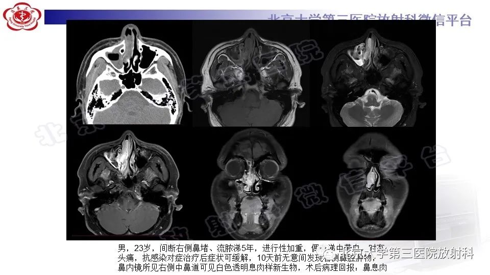 影像PPT - 【PPT】鼻腔鼻窦恶性黑色素瘤-21