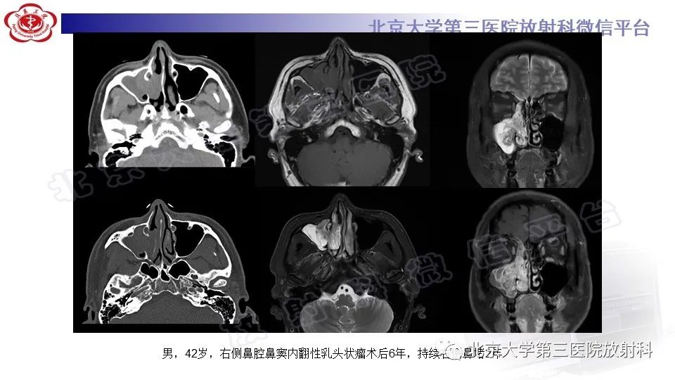 影像PPT - 【PPT】鼻腔鼻窦恶性黑色素瘤-23