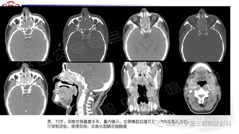 影像PPT - 【PPT】鼻腔鼻窦恶性黑色素瘤-25