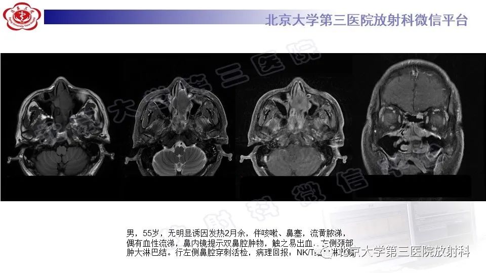 影像PPT - 【PPT】鼻腔鼻窦恶性黑色素瘤-27
