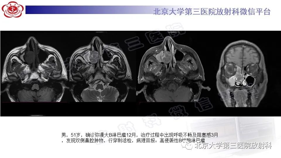 影像PPT - 【PPT】鼻腔鼻窦恶性黑色素瘤-28