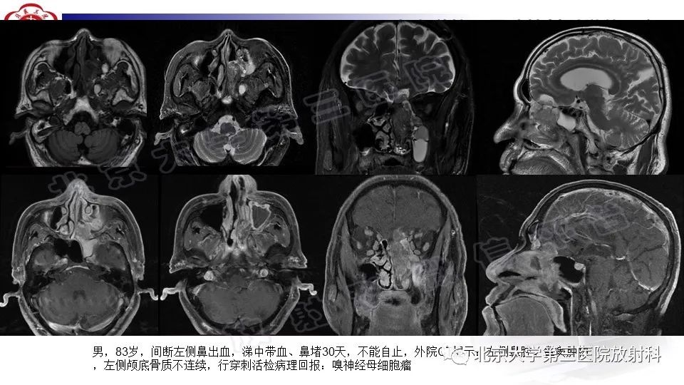 影像PPT - 【PPT】鼻腔鼻窦恶性黑色素瘤-30