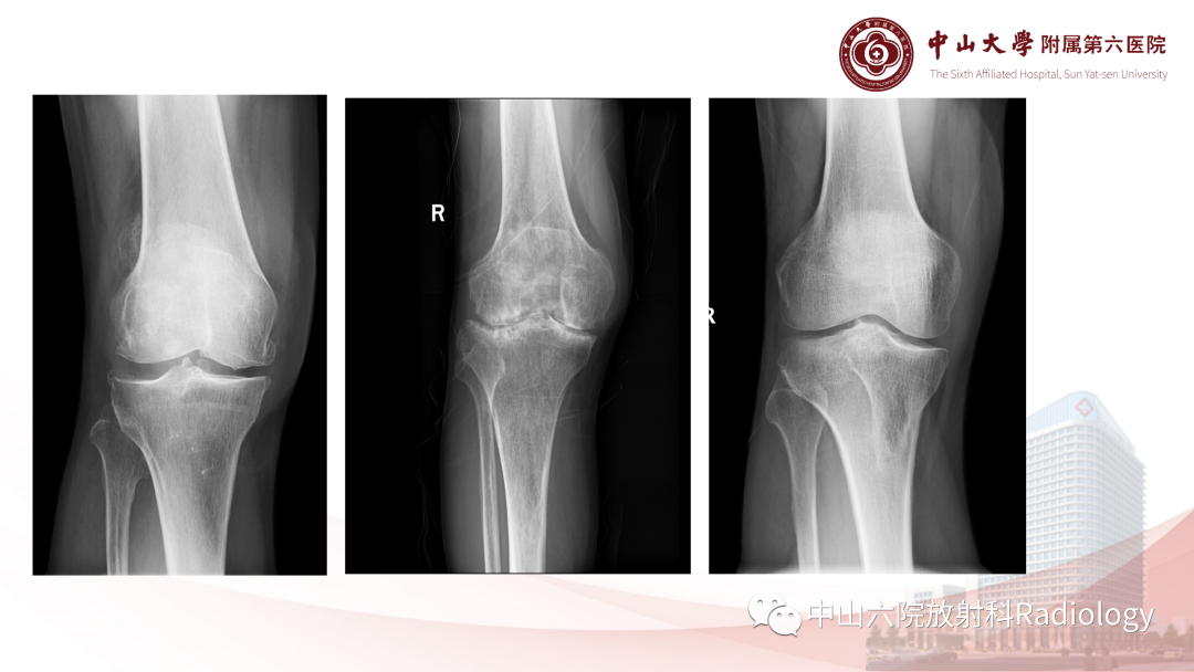 影像PPT - 【PPT】退行性骨关节病-1
