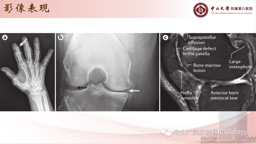 影像PPT - 【PPT】退行性骨关节病-10