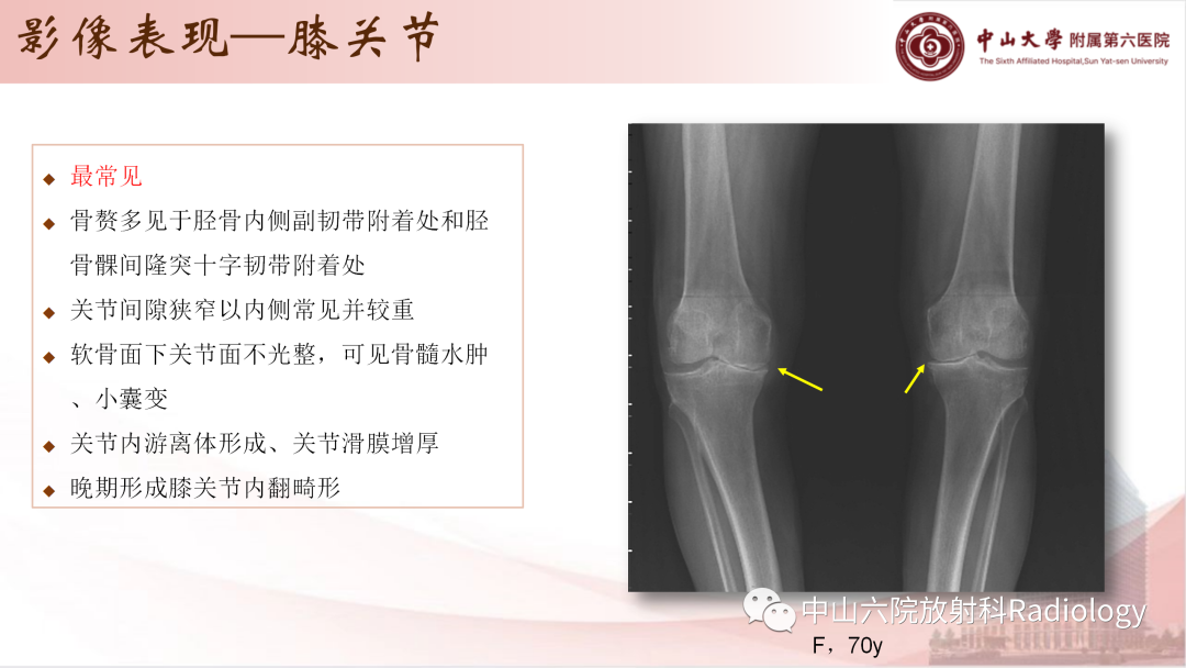 影像PPT - 【PPT】退行性骨关节病-12