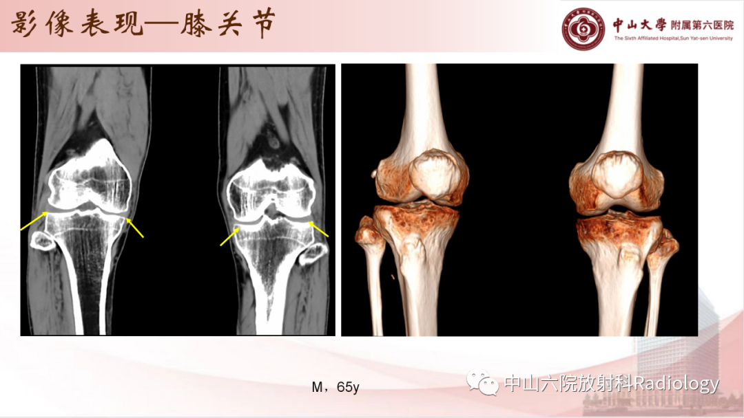 影像PPT - 【PPT】退行性骨关节病-14