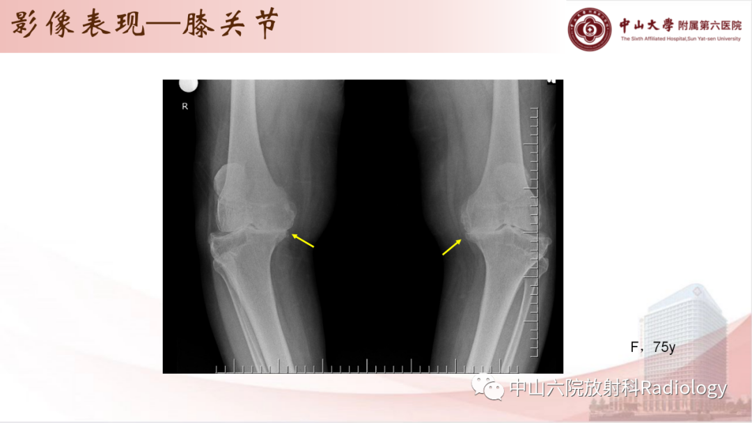 影像PPT - 【PPT】退行性骨关节病-13