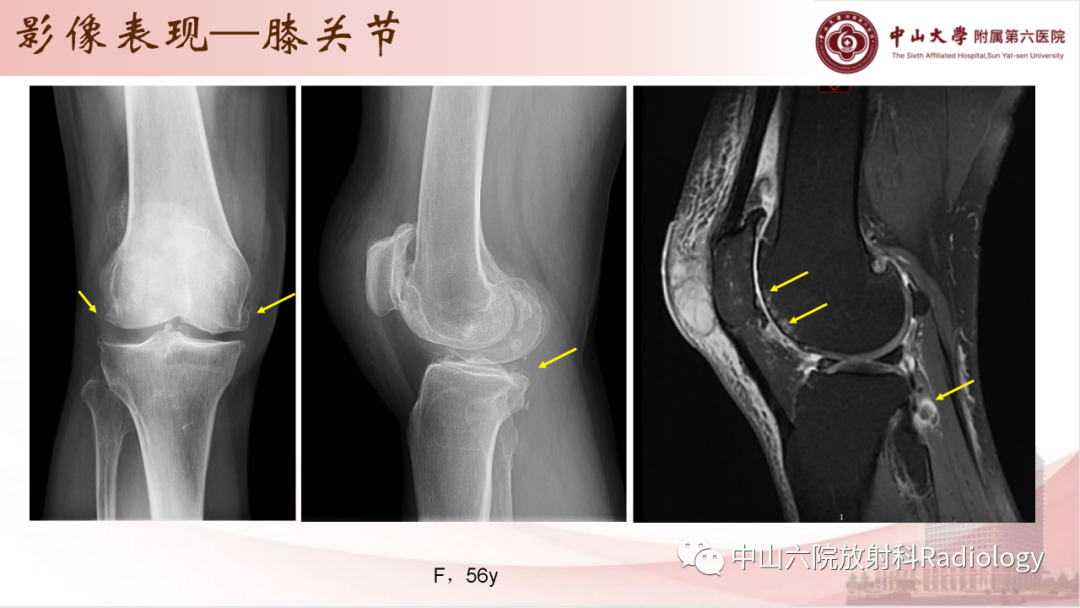 影像PPT - 【PPT】退行性骨关节病-15