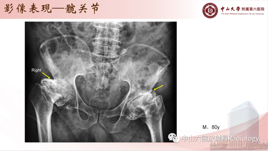 影像PPT - 【PPT】退行性骨关节病-18