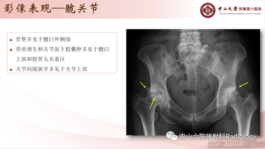 影像PPT - 【PPT】退行性骨关节病-17