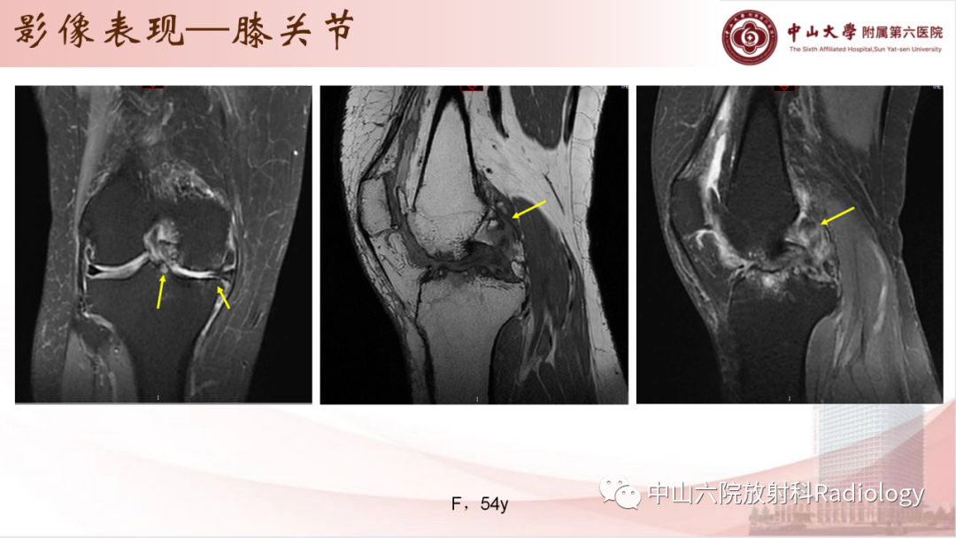 影像PPT - 【PPT】退行性骨关节病-16