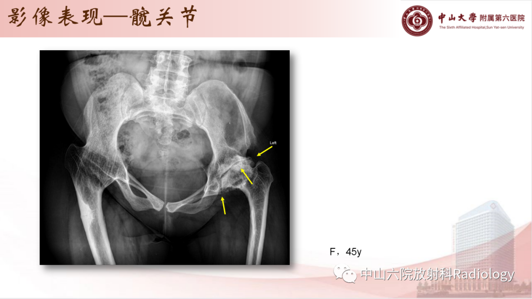 影像PPT - 【PPT】退行性骨关节病-19