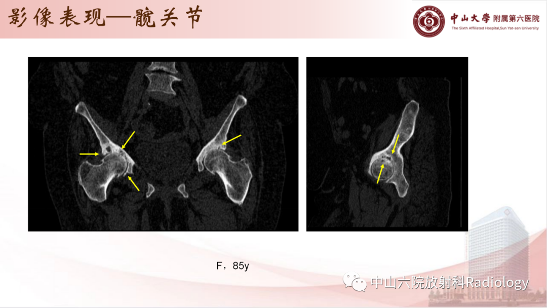 影像PPT - 【PPT】退行性骨关节病-20