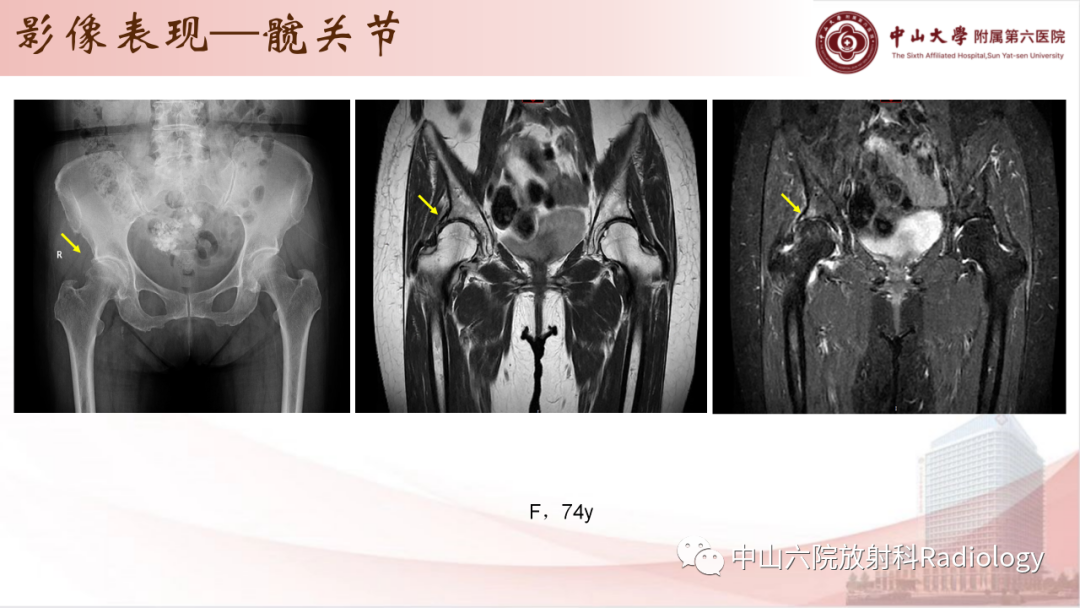 影像PPT - 【PPT】退行性骨关节病-21