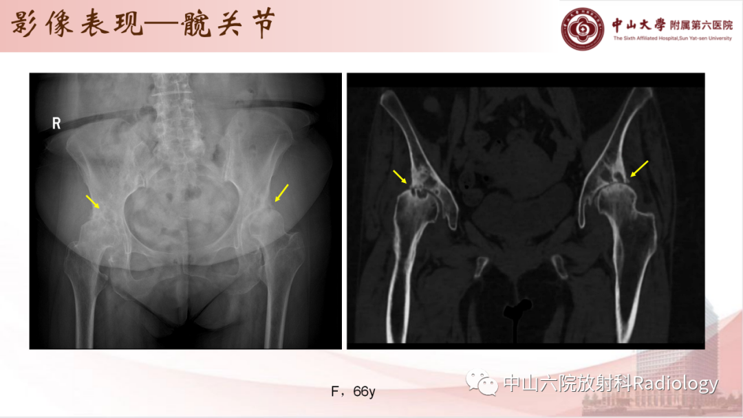 影像PPT - 【PPT】退行性骨关节病-22