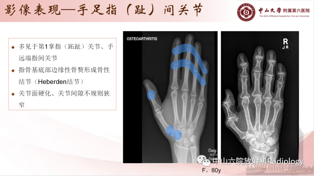 影像PPT - 【PPT】退行性骨关节病-23