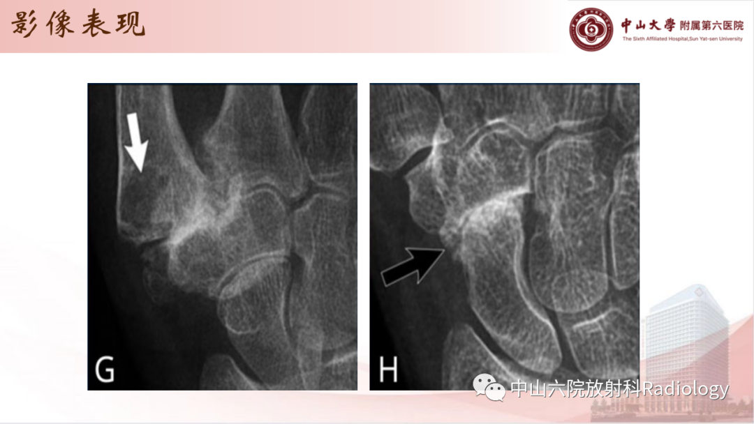 影像PPT - 【PPT】退行性骨关节病-25