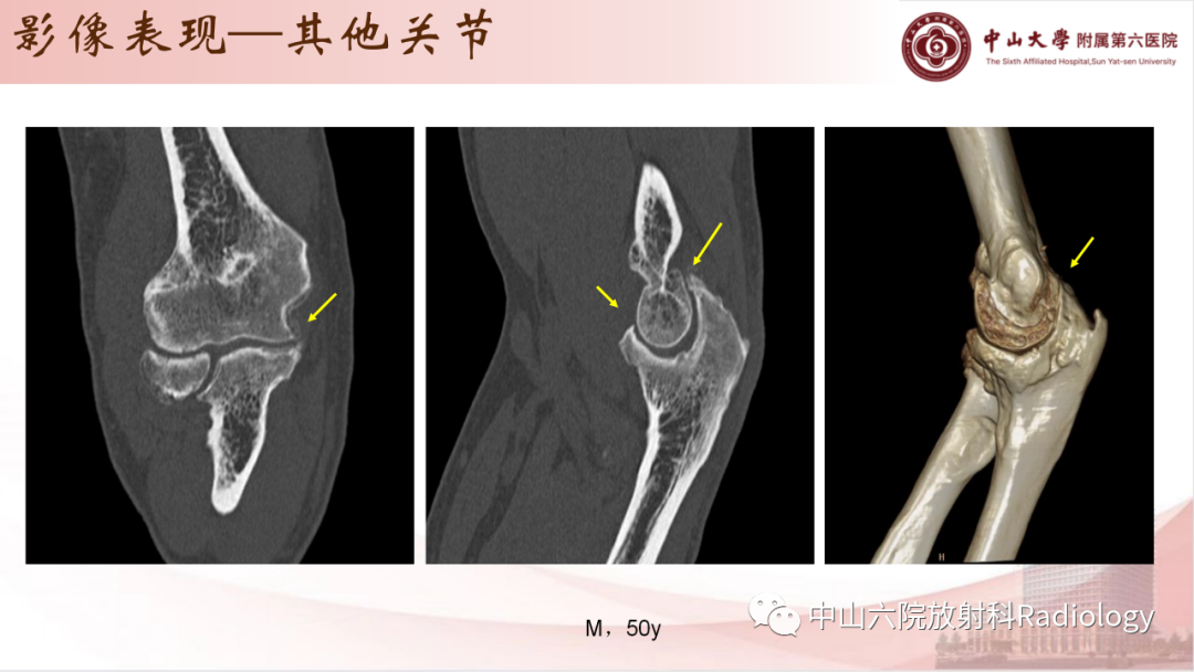 影像PPT - 【PPT】退行性骨关节病-26