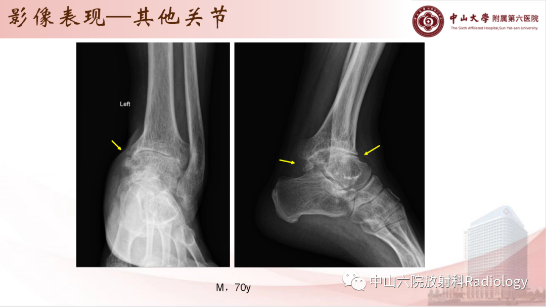 影像PPT - 【PPT】退行性骨关节病-27