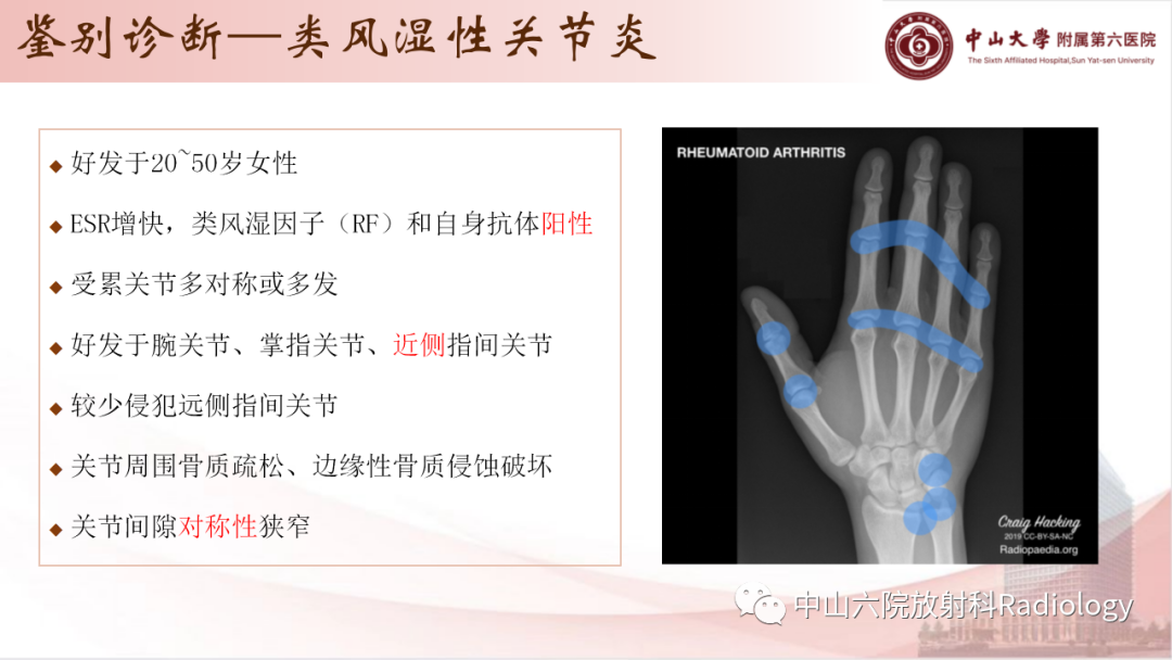 影像PPT - 【PPT】退行性骨关节病-29