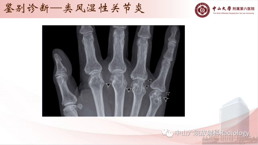 影像PPT - 【PPT】退行性骨关节病-30
