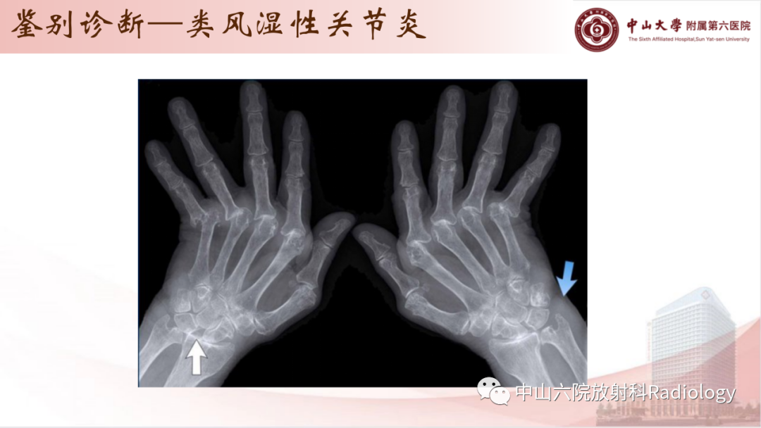 影像PPT - 【PPT】退行性骨关节病-31