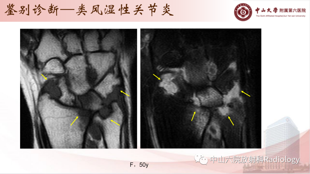 影像PPT - 【PPT】退行性骨关节病-32