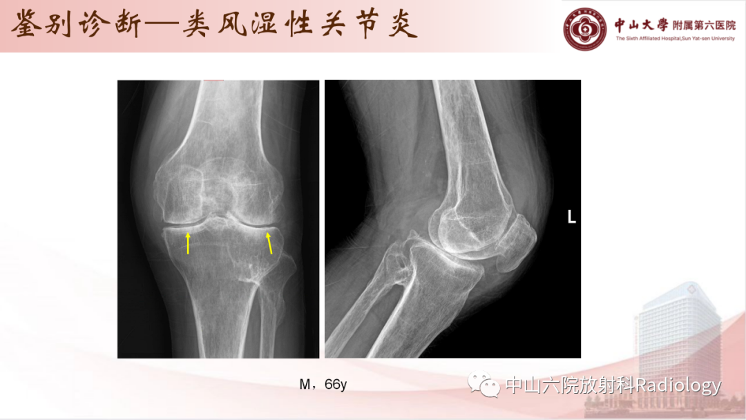 影像PPT - 【PPT】退行性骨关节病-34