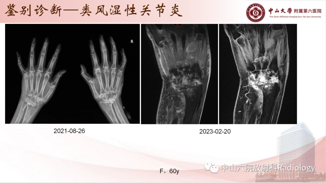 影像PPT - 【PPT】退行性骨关节病-33