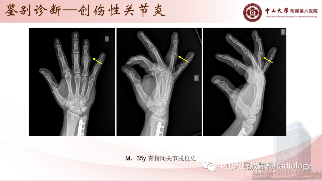 影像PPT - 【PPT】退行性骨关节病-36