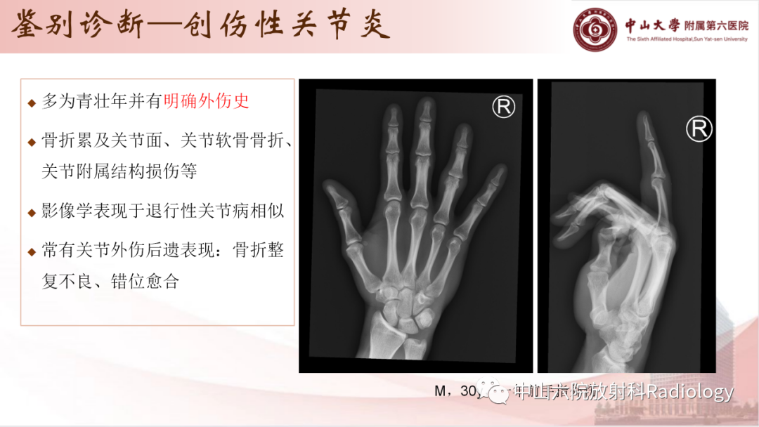 影像PPT - 【PPT】退行性骨关节病-35