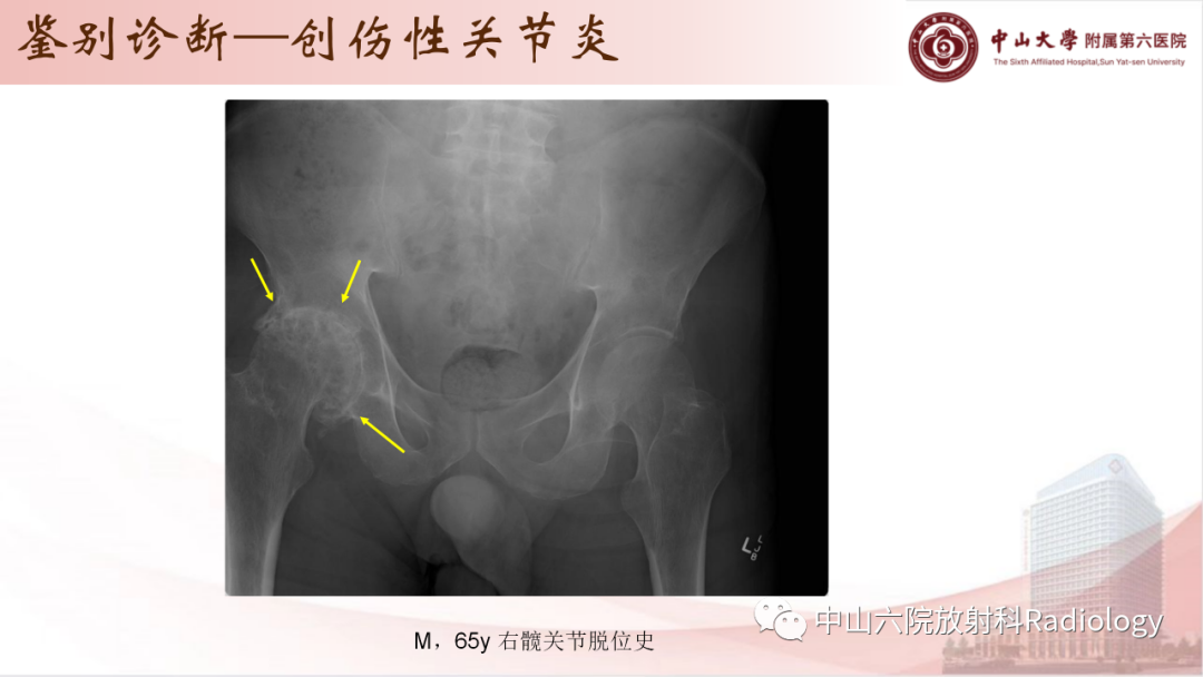 影像PPT - 【PPT】退行性骨关节病-37