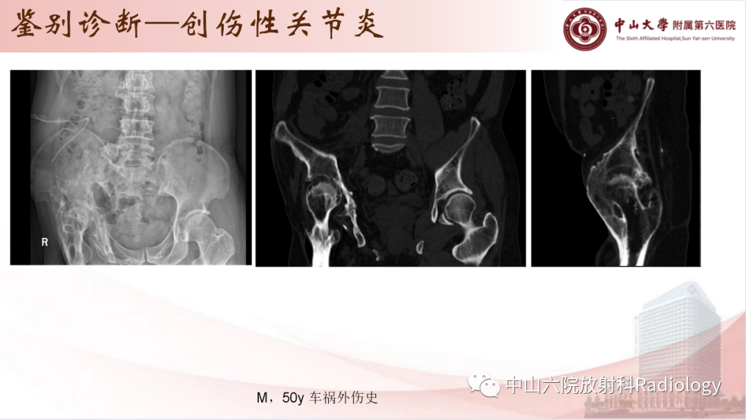 影像PPT - 【PPT】退行性骨关节病-38