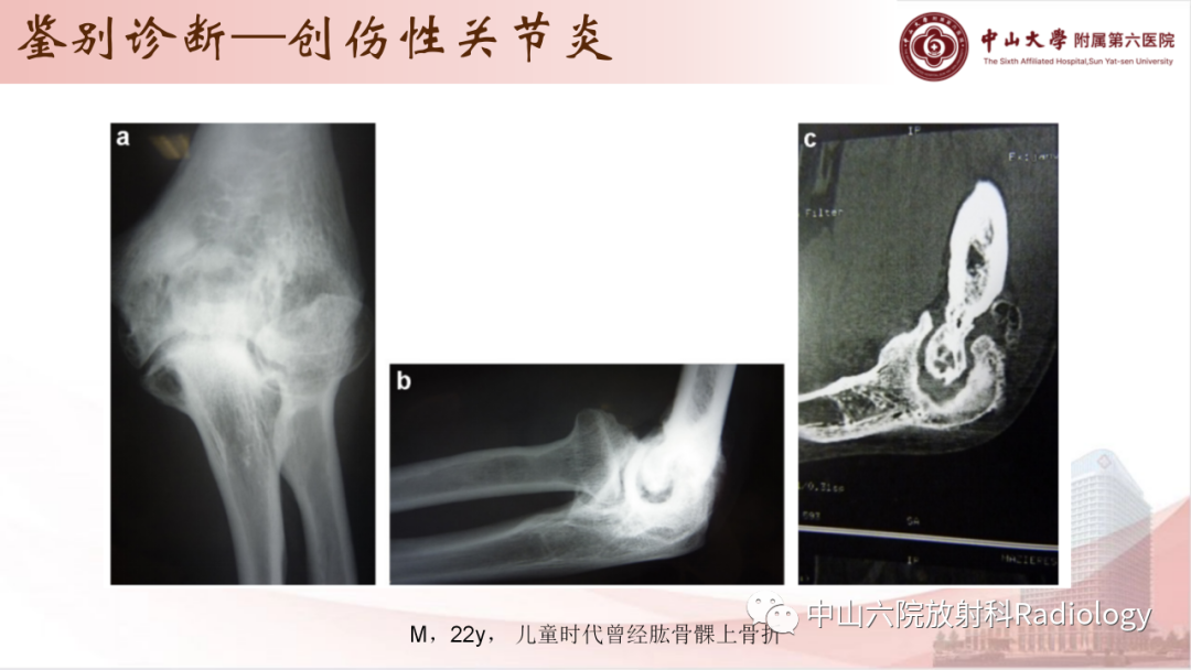 影像PPT - 【PPT】退行性骨关节病-39
