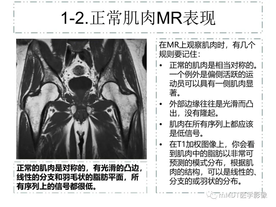 影像PPT - 【PPT】肌肉MR-创伤性异常-4 影像PPT - 【PPT】肌肉MR-创伤性异常-4