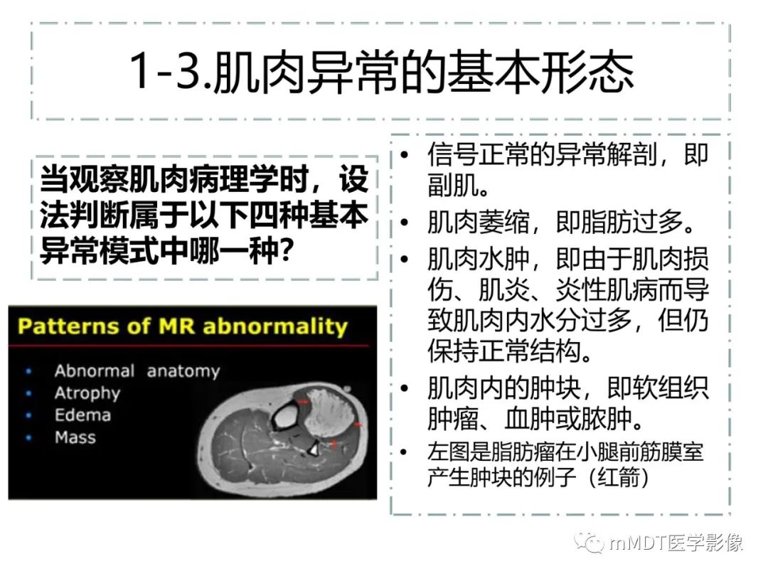 影像PPT - 【PPT】肌肉MR-创伤性异常-5 影像PPT - 【PPT】肌肉MR-创伤性异常-5