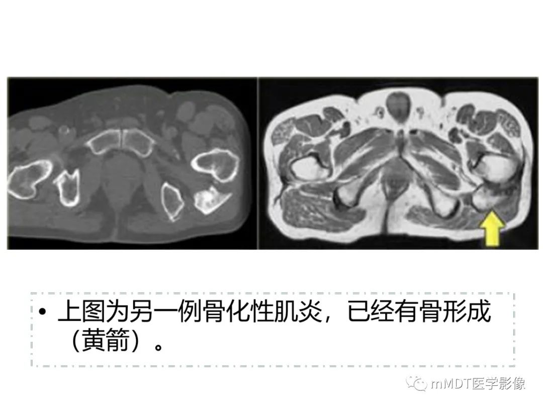 影像PPT - 【PPT】肌肉MR-创伤性异常-39 影像PPT - 【PPT】肌肉MR-创伤性异常-39